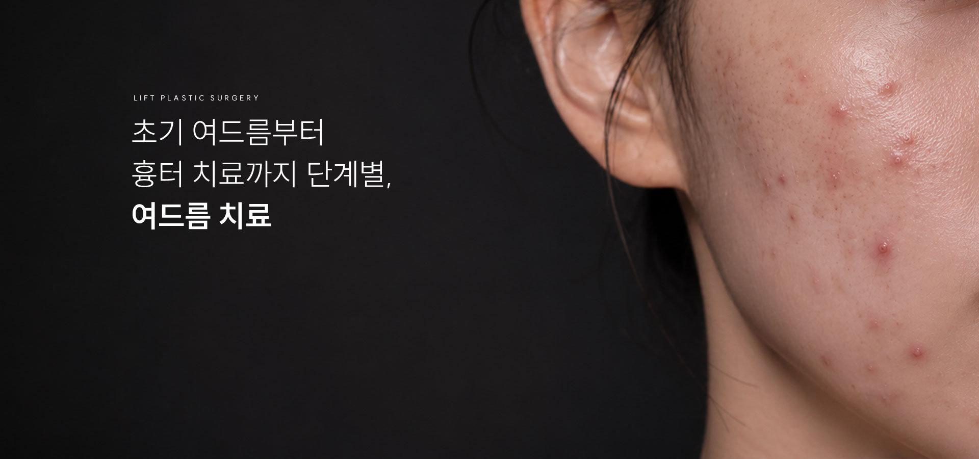 
	초기 여드름부터 흉터 치료까지 단계별, 여드름 치료
	