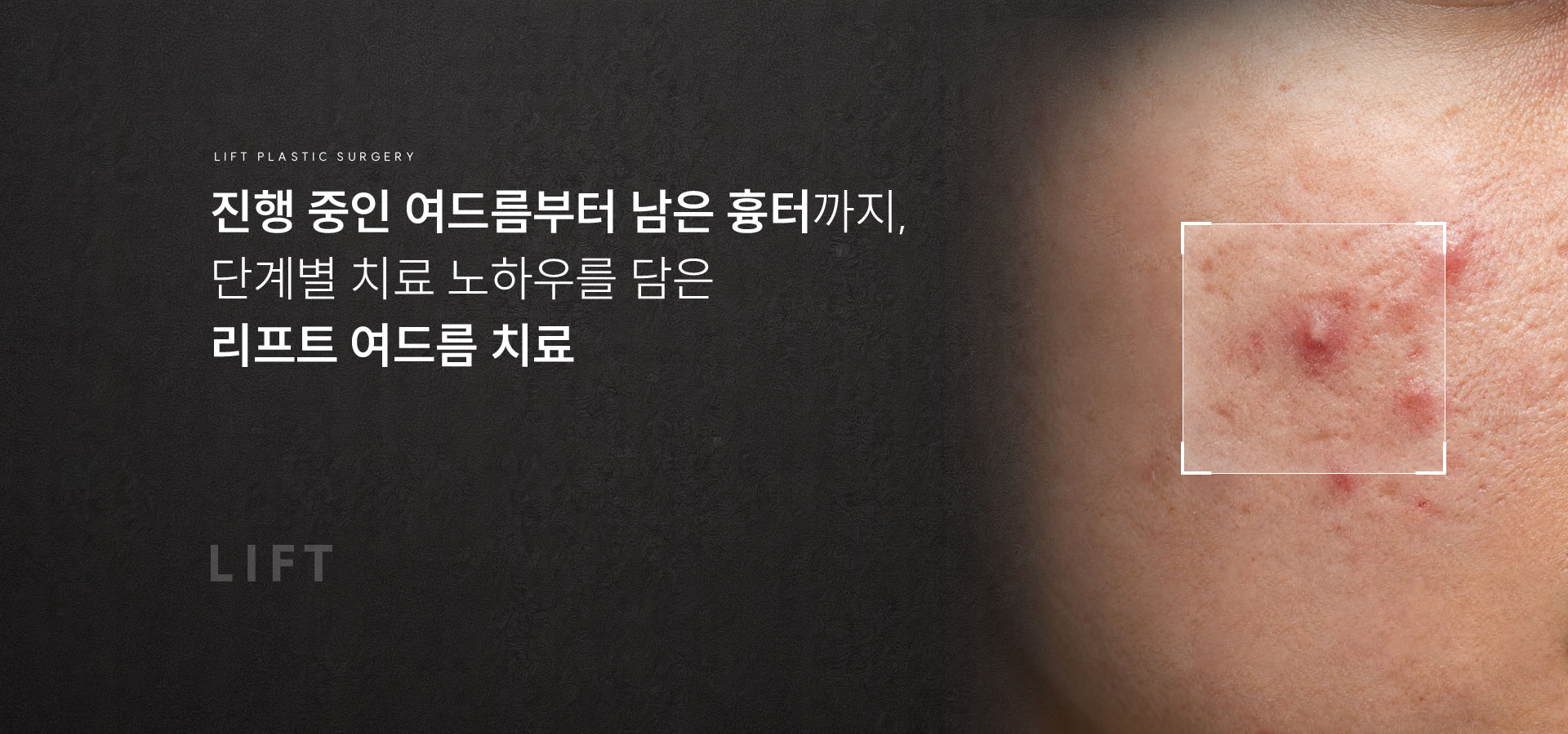 
	v1.	리프트는 어떻게 여드름부터 흉터까지 단계별로 치료할까?
	