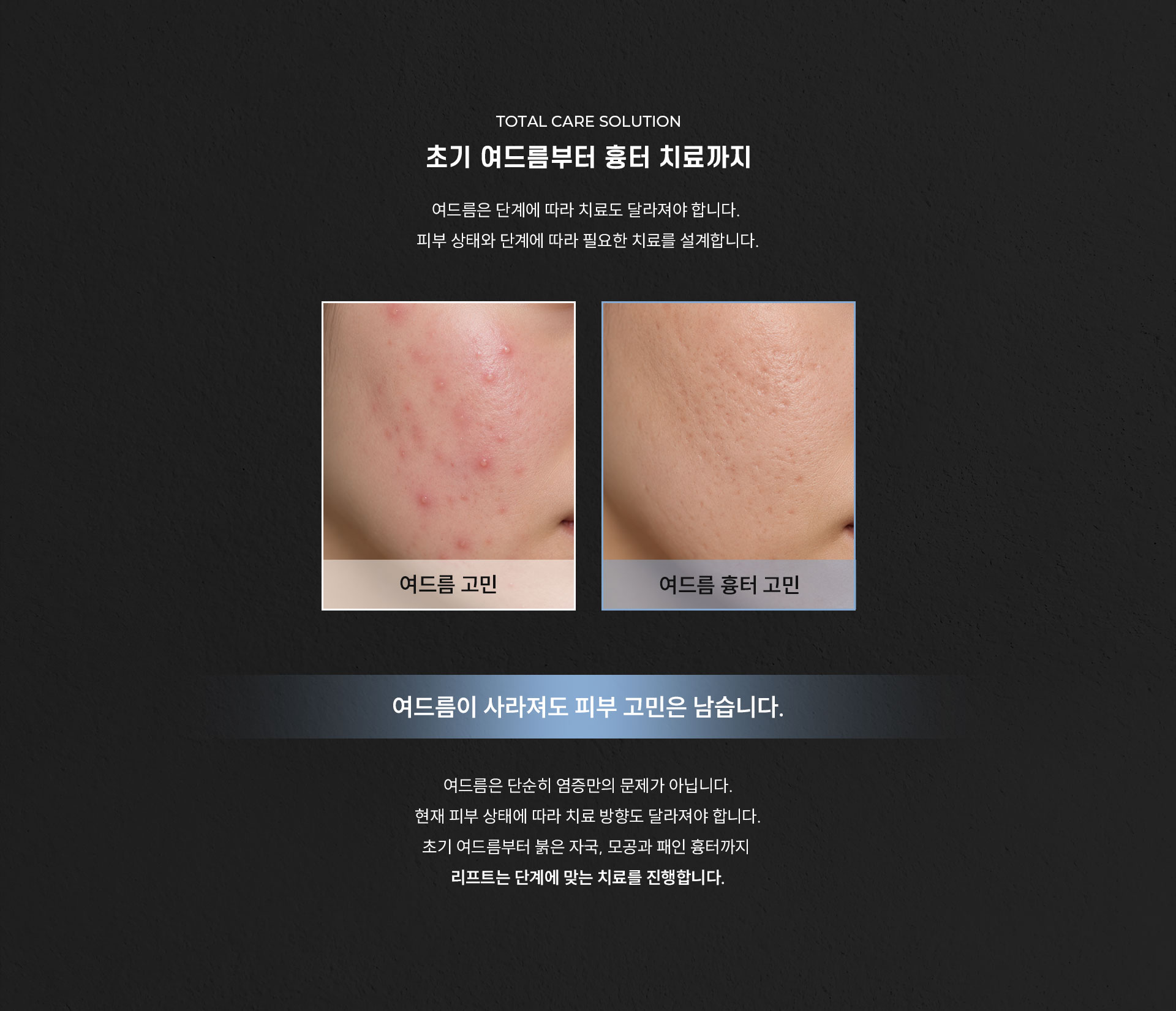 
	Q. 초기 여드름부터 흉터까지, 단계별 치료가 필요한 이유는 무엇인가요?
	A. 여드름은 단계에 따라 치료도 달라져야 합니다. 피부 상태와 단계에 따라 필요한 치료를 설계합니다.
	여드름이 사라져도 피부 고민은 남습니다.
	여드름은 단순히 염증만의 문제가 아닙니다. 현재 피부 상태에 따라 치료 방향도 달라져야 합니다.
	초기 여드름부터 붉은 자국, 모공과 패인 흉터까지 리프트는 단계에 맞는 치료를 진행합니다.
	