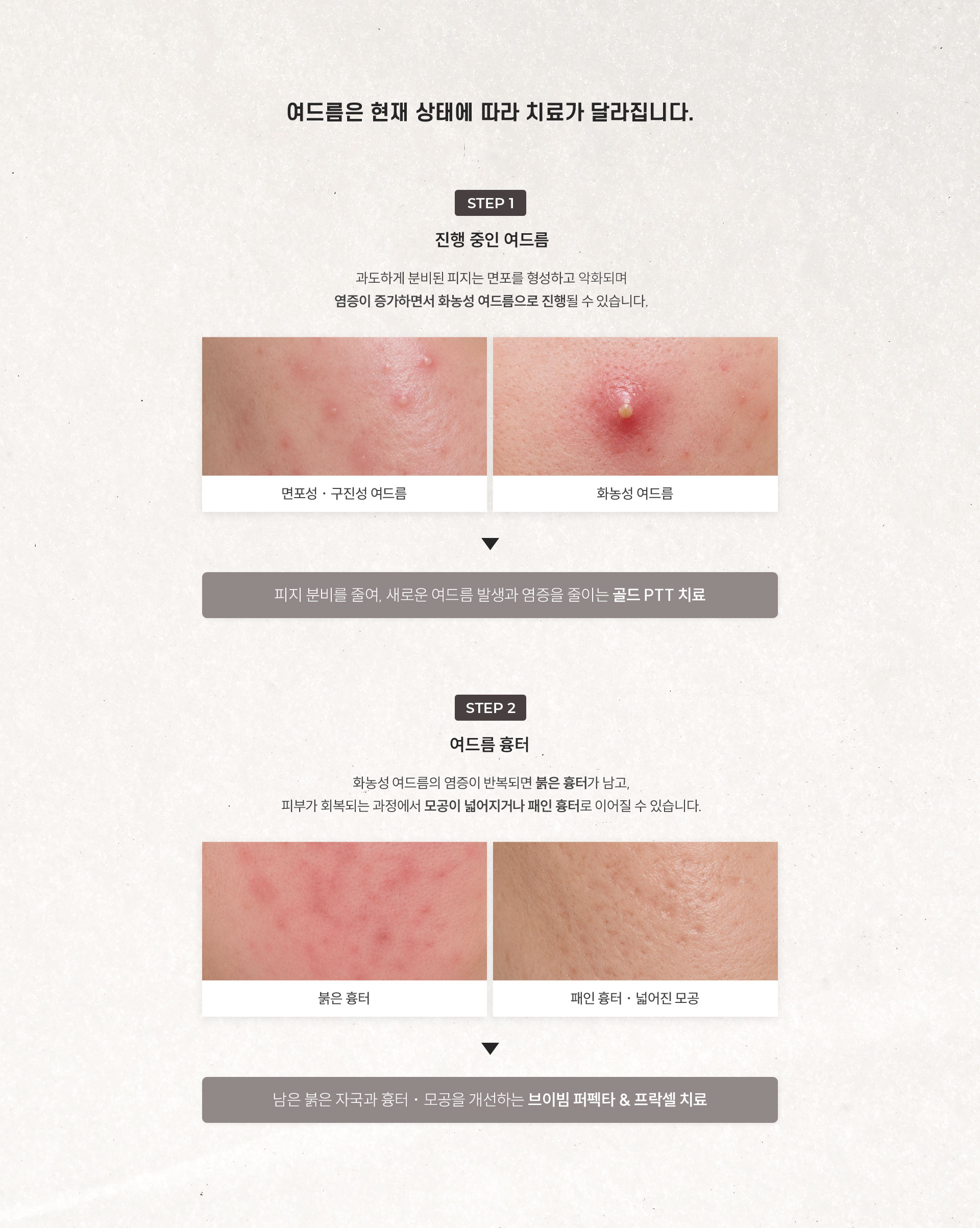 
	2.	여드름은 상태에 따라 치료가 달라질까?
	STEP 1 – 진행중인 여드름
	과도하게 분비된 피지는 면포를 형성하고 악화하며 염증이 증가하면서 화농성 여드름으로 진행될 수 있습니다.
	면포성 ∙ 구진성 여드름 / 화농성 여드름
	피지 분비를 줄여, 새로운 여드름 발생과 염증을 줄이는 골드 PTT 치료

	STEP 2 – 여드름 흉터
	화농성 여드름의 염증이 반복되면 붉은 흉터가 남고, 피부가 회복되는 과정에서 모공이 넓어지거나 패인 흉터로 이어질 수 있습니다.
	붉은 흉터 / 패인 흉터 ∙ 넓어진 모공
	남은 붉은 자국과 흉터 ∙ 모공을 개선하는 브이빔 퍼펙타 & 프락셀 치료
	