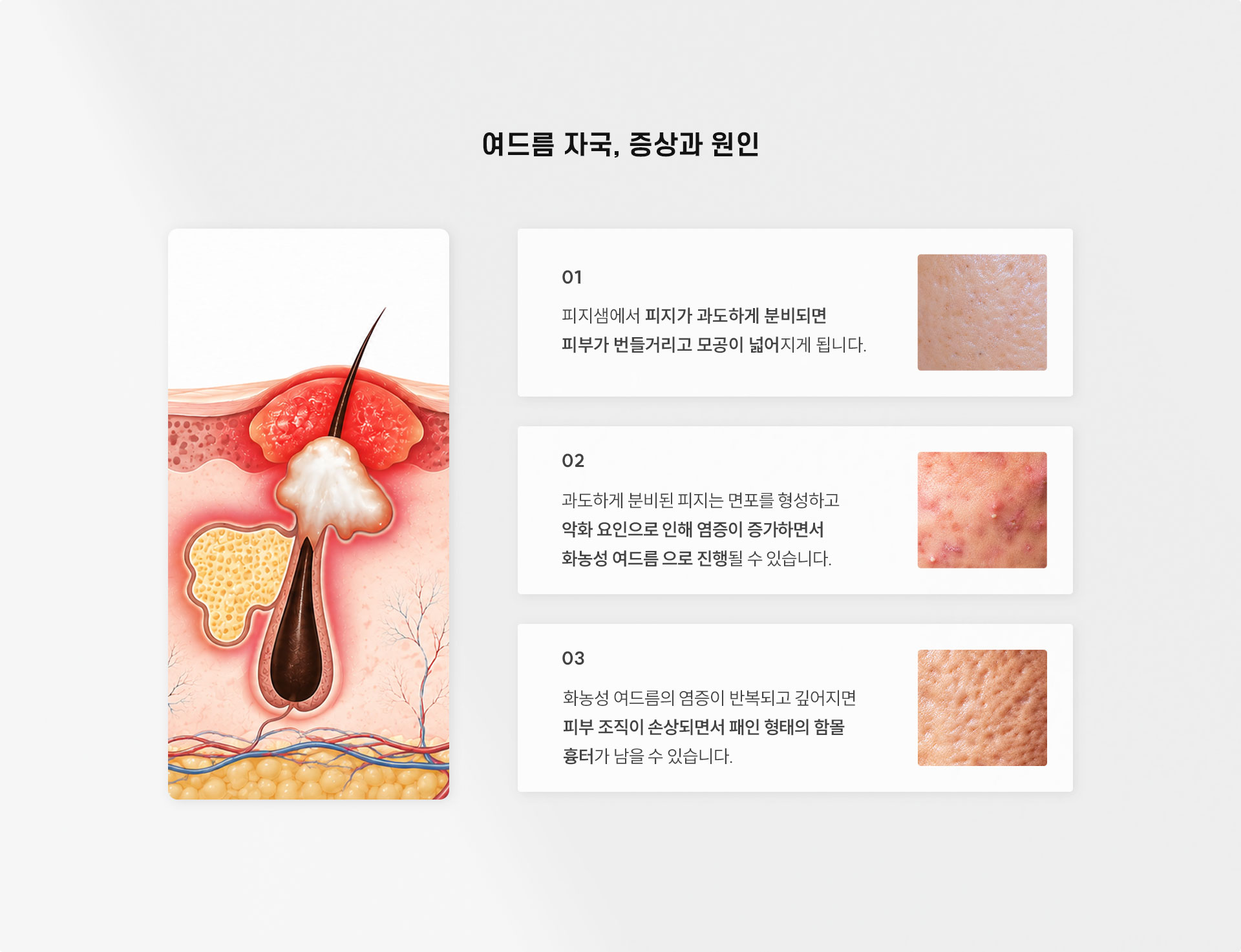 
	Q. 여드름 자국은 어떻게 생기나요?
	A.
	1. 피지샘에서 피지가 과도하게 분비되면 피부가 번들거리고 모공이 넓어지게 됩니다.
	2. 과도하게 분비된 피지는 면포를 형성하고 악화 요인으로 인해 염증이 증가하면서 화농성 여드름으로 진행될 수 있습니다.
	3. 화농성 여드름의 염증이 반복되고 깊어지면 피부 조직이 손상되면서 패인 형태의 함몰 흉터가 남을 수 있습니다.
	