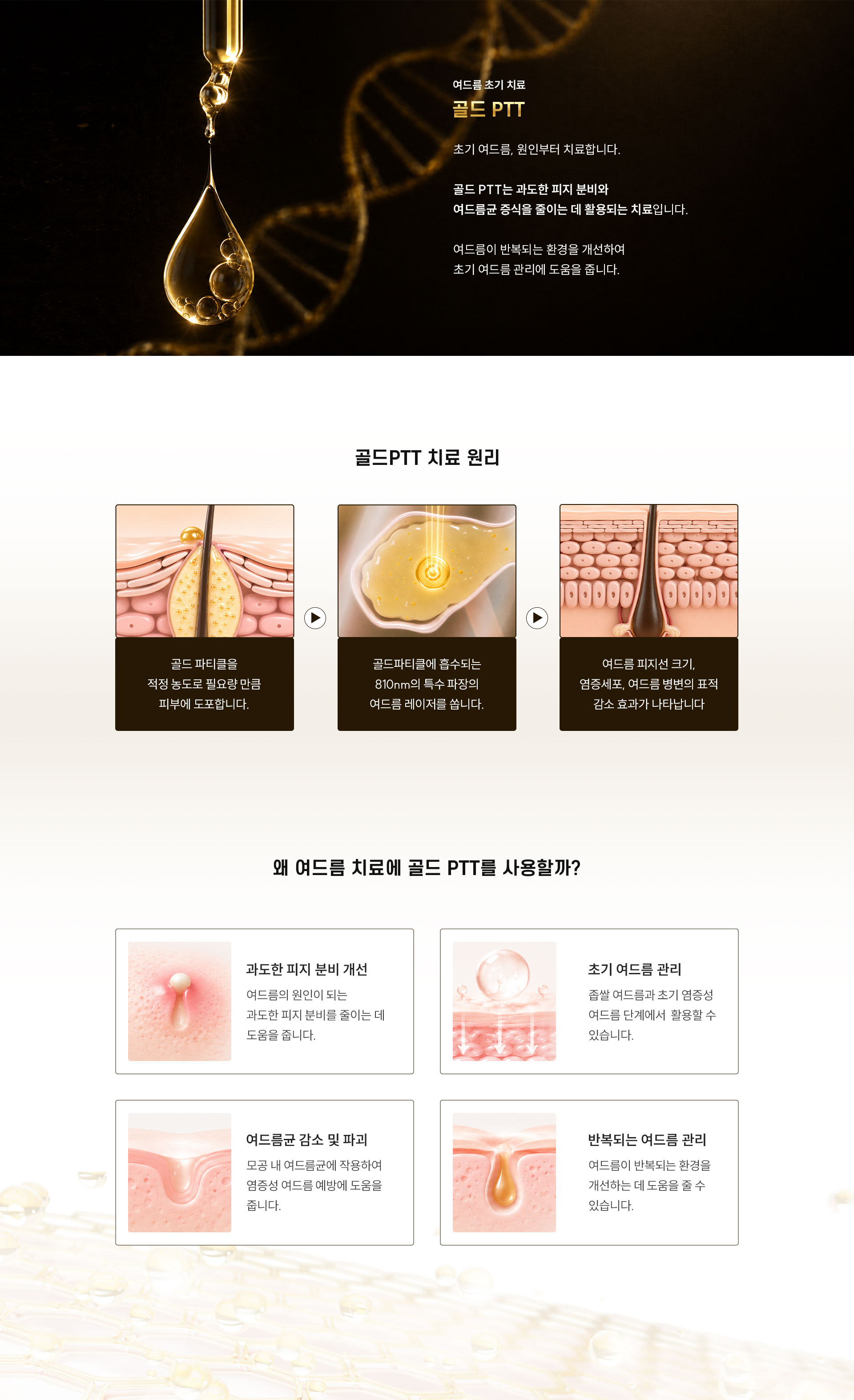 
		Q. 초기 여드름에는 왜 골드 PTT 치료를 사용할까요?
		A. 초기 여드름, 원인부터 치료합니다. 골드 PTT는 과도한 피지 분비와 여드름균 증식을 줄이는 데 활용되는 치료입니다. 여드름이 반복되는 환경을 개선하여 초기 여드름 관리에 도움을 줍니다.
		- 골드 PTT 치료 원리
		•	골드 파티클을 적정 농도로 필요량 만큼 피부에 도포합니다.
		•	골드파티클에 흡수되는 810nm의 특수 파장의 여드름 레이저를 쏩니다.
		•	여드름 피지선 크기, 염증세포, 여드름 병변의 표적 감소 효과가 나타납니다.
		- 왜 여드름 치료에 골드 PTT를 사용할까?
		1. 과도한 피지 분비 개선
		•	여드름의 원인이 되는 과도한 피지 분비를 줄이는 데 도움을 줍니다.
		2. 초기 여드름 관리
		•	좁쌀 여드름과 초기 염증성 여드름 단계에서 활용할 수 있습니다.
		3. 여드름균 감소 및 파괴
		•	모공 내 여드름균에 작용하여 염증성 여드름 예방에 도움을 줍니다.
		4. 반복되는 여드름 관리
		•	여드름이 반복되는 환경을 개선하는 데 도움을 줄 수 있습니다.
		