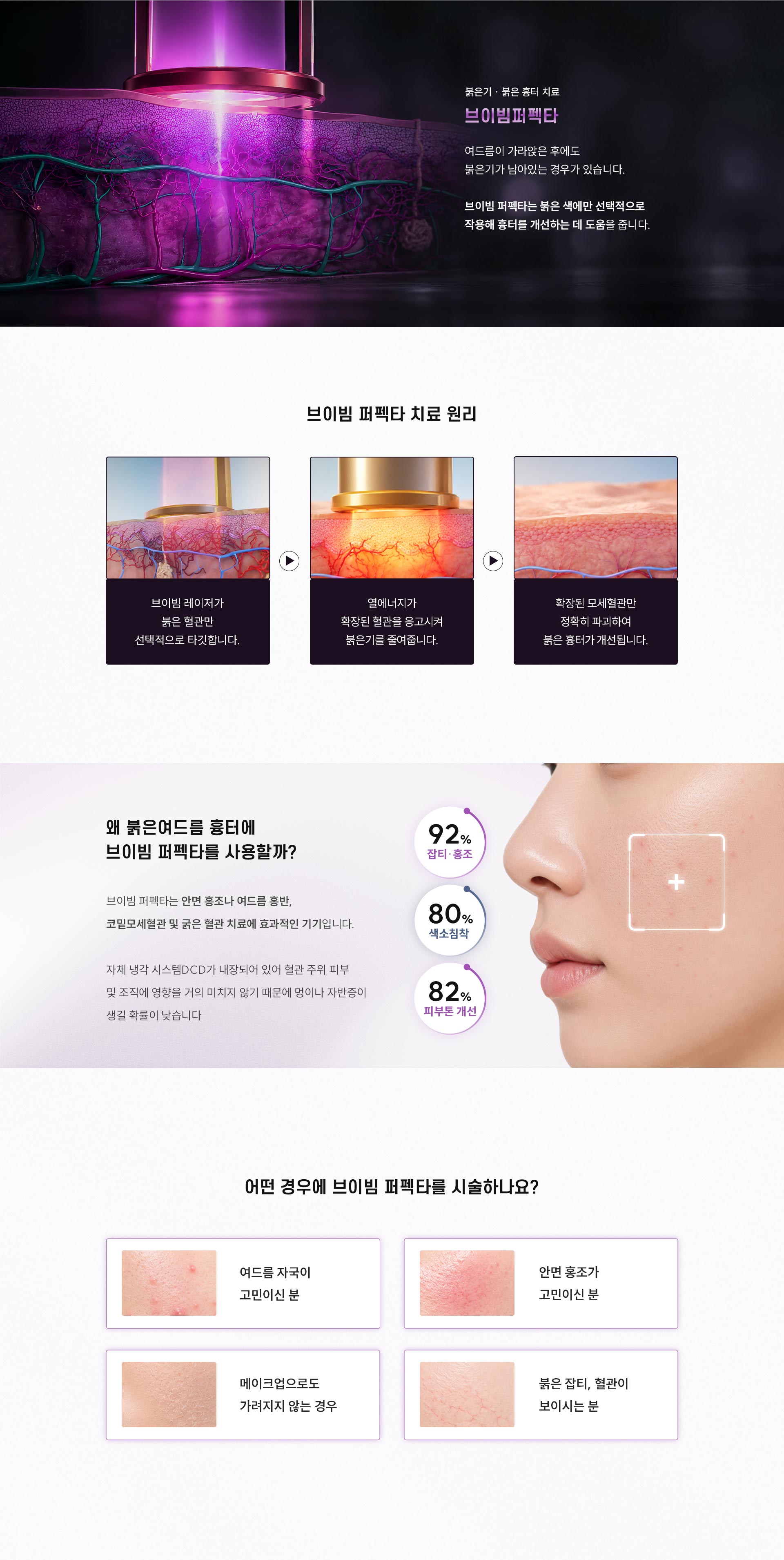 
		Q. 여드름 붉은기와 붉은 흉터에는 왜 브이빔 퍼펙타를 사용할까요?
		A. 여드름이 가라앉은 후에도 붉은기가 남아있는 경우가 있습니다. 브이빔 퍼펙타는 붉은색에만 선택적으로 작용해 흉터를 개선하는 데 도움을 줍니다.
		- 브이빔퍼펙타 치료 원리
		•	브이빔 레이저가 붉은 혈관만 선택적으로 타깃합니다.
		•	열에너지가 확장된 혈관을 응고시켜 붉은기를 줄여줍니다.
		•	확장된 모세혈관만 정확히 파괴하여 붉은 흉터가 개선됩니다.
		- 왜 붉은여드름 흉터에 브이빔 퍼펙타를 사용할까?
		•	브이빔 퍼펙타는 안면 홍조나 여드름 홍반, 코밑모세혈관 및 굵은 혈관 치료에 효과적인 기기입니다. 자체 냉각 시스템 DCD가 내장되어 있어 혈관 주위 피부 및 조직에 영향을 거의 미치지 않기 때문에 멍이나 자반증이 생길 확률이 낮습니다.
		- 어떤 경우에 브이빔 퍼펙타를 시술하나요?
		•	여드름 자국이 고민이신 분
		•	안면 홍조가 고민이신 분
		•	메이크업으로도 가려지지 않는 경우
		•	붉은 잡티, 혈관이 보이시는 분
		