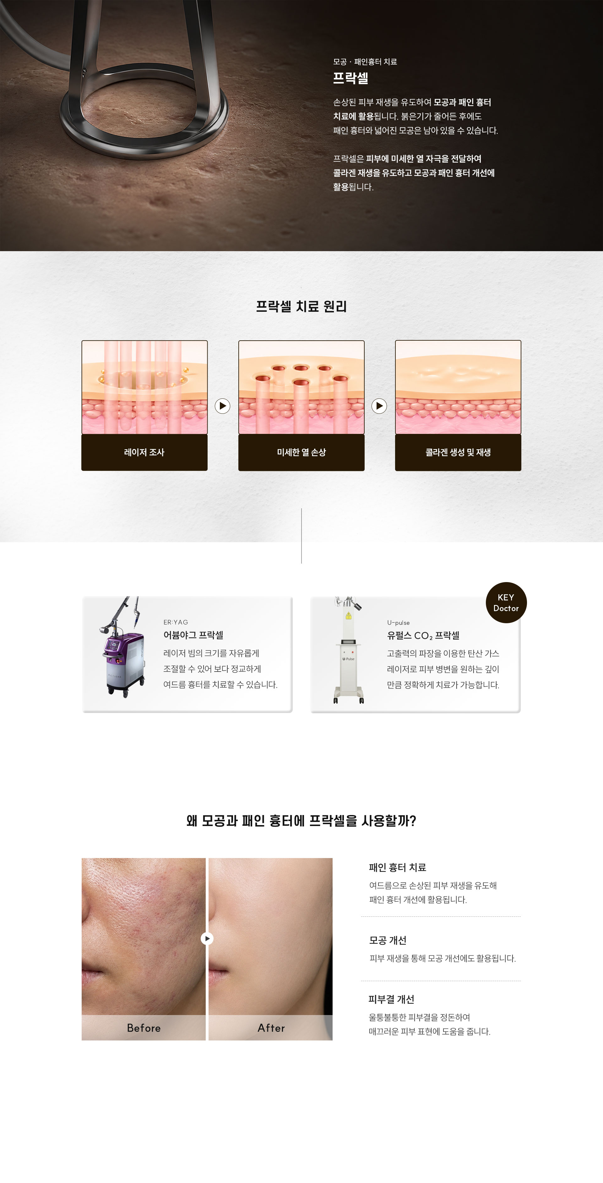
		Q. 모공과 패인 흉터에는 왜 프락셀 치료를 사용할까요?
		A. 손상된 피부 재생을 유도하여 모공과 패인 흉터 치료에 활용됩니다. 붉은기가 줄어든 후에도 패인 흉터와 넓어진 모공은 남아 있을 수 있습니다. 프락셀은 피부에 미세한 열 자극을 전달하여 콜라겐 재생을 유도하고 모공과 패인 흉터 개선에 활용됩니다.
		- 프락셀 치료 원리
		•	레이저 조사
		•	미세한 열 손상
		•	콜라겐 생성 및 재생
		1. 어븀야그 프락셀
		•	레이저 빔의 크기를 자유롭게 조절할 수 있어 보다 정교하게 여드름 흉터를 치료할 수 있습니다.
		2. 유펄스 CO₂ 프락셀
		•	고출력의 파장을 이용한 탄산 가스 레이저로 피부 병변을 원하는 깊이 만큼 정확하게 치료가 가능합니다.

		Q. 왜 모공과 패인 흉터에 프락셀을 사용할까요?
		A.
		1. 패인 흉터 치료
		•	여드름으로 손상된 피부 재생을 유도해 패인 흉터 개선에 활용됩니다.
		2. 모공 개선
		•	피부 재생을 통해 모공 개선에도 활용됩니다.
		3. 피부결 개선
		•	울퉁불퉁한 피부결을 정돈하여 매끄러운 피부 표현에 도움을 줍니다.
		