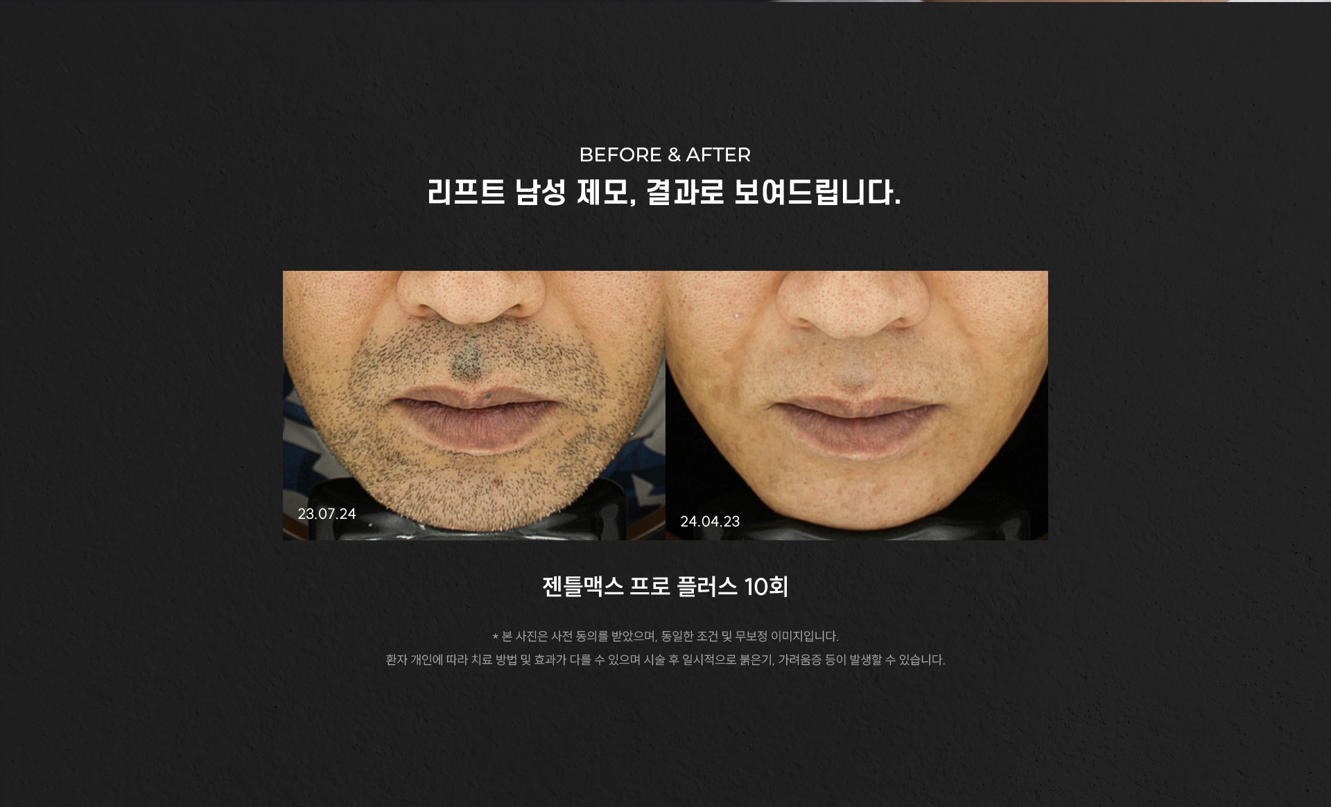 
	1.	before & after 전후사진으로 보는 리프트 남성 제모의 결과는?
	젠틀맥스 프로 플러스 10회
	* 본 사진은 사전 동의를 받았으며, 동일한 조건 및 무보정 이미지입니다. 환자 개인에 따라 치료 방법 및 효과가 다를 수 있으며 시술 후 일시적으로 붉은기, 가려움증 등이 발생할 수 있습니다.
	