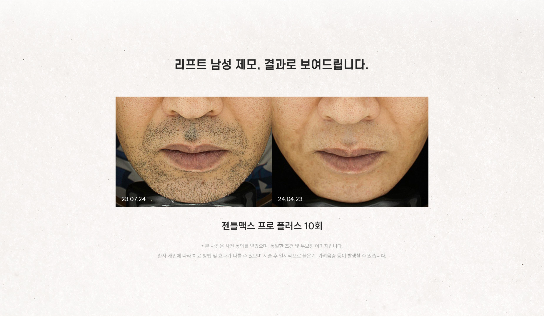 
	1.	before & after 전후사진으로 보는 리프트 남성 제모의 결과는?
	젠틀맥스 프로 플러스 10회
	* 본 사진은 사전 동의를 받았으며, 동일한 조건 및 무보정 이미지입니다. 환자 개인에 따라 치료 방법 및 효과가 다를 수 있으며 시술 후 일시적으로 붉은기, 가려움증 등이 발생할 수 있습니다.
	