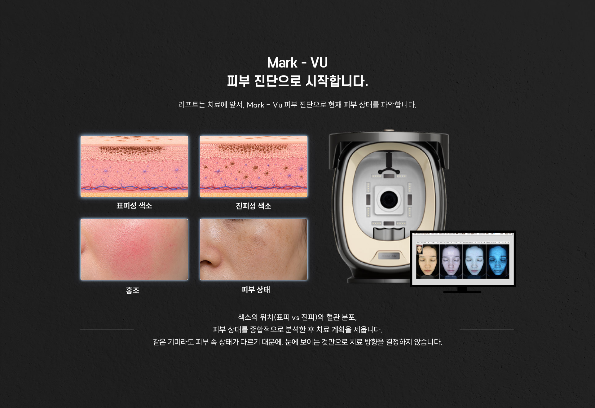 
	3.	Mark-VU 피부 진단으로 먼저 확인하는 이유는 무엇인가요?
	리프트는 치료에 앞서, Mark-VU 피부 진단으로 현재 피부 상태를 파악합니다.
	- 표피성 색소
	- 진피성 색소
	- 홍조
	- 피부 상태
	색소의 위치, 즉 표피와 진피 중 어디에 위치하는지와 혈관 분포, 피부 상태를 종합적으로 분석한 후 치료 계획을 세웁니다.
	같은 기미라도 피부 속 상태가 다르기 때문에, 눈에 보이는 것만으로 치료 방향을 결정하지 않습니다.
	