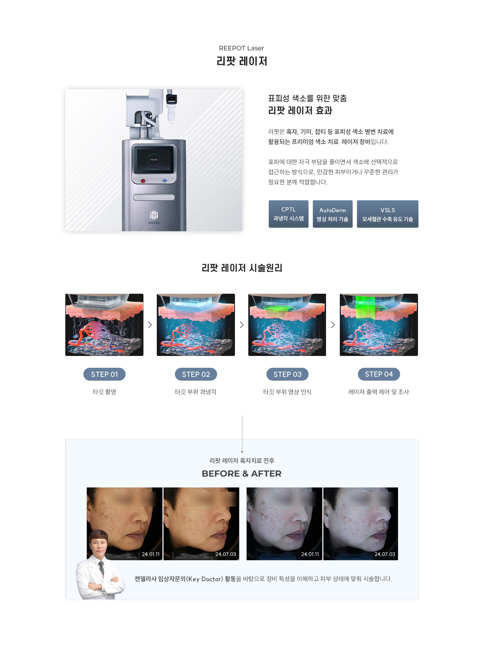 
		6.	표피성 색소를 위한 맞춤 대구리팟 레이저란?
		리팟은 흑자, 기미, 잡티 등 표피성 색소 병변 치료에 활용되는 프리미엄 색소 치료 레이저 장비입니다.
		표피에 대한 자극 부담을 줄이면서 색소에 선택적으로 접근하는 방식으로, 민감한 피부이거나 꾸준한 관리가 필요한 분께 적합합니다.
		- CPTL 과냉각 시스템
		- AutoDerm 영상 처리 기술
		- VSLS 모세혈관 수축 유도 기술
		리팟 레이저 시술 원리
		1)	타깃 촬영
		2)	타깃 부위 과냉각
		3)	타깃 부위 영상 인식
		4)	레이저 출력 제어 및 조사
		리팟레이저 켄델라 임상자문의 Candela Key Doctor
		켄델라사 임상자문의(Key Doctor) 활동을 바탕으로 장비 특성을 이해하고 피부 상태에 맞춰 시술합니다.
		