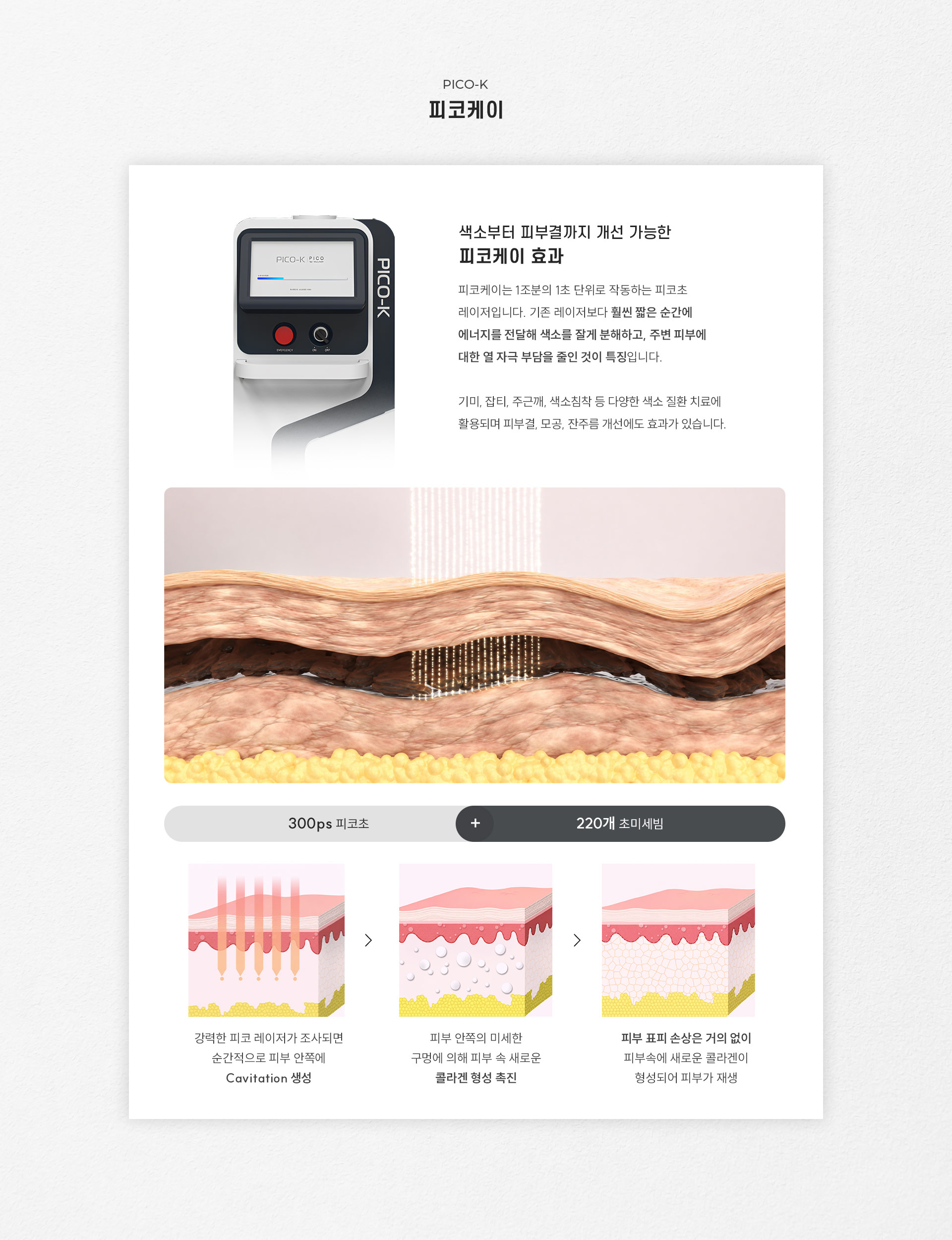 
		7.	색소부터 피부결까지 개선 가능한 대구피코케이란?
		피코케이는 1조분의 1초 단위로 작동하는 피코초 레이저입니다.
		기존 레이저보다 훨씬 짧은 순간에 에너지를 전달해 색소를 잘게 분해하고, 주변 피부에 대한 열 자극 부담을 줄인 것이 특징입니다.
		기미, 잡티, 주근깨, 색소침착 등 다양한 색소 질환 치료에 활용되며 피부결, 모공, 잔주름 개선에도 효과가 있습니다.
		- 300ps 피코초
		- 220개 초미세빔
		피코케이 시술 원리
		1)	강력한 피코 레이저가 조사되면 순간적으로 피부 안쪽에 Cavitation 생성
		2)	피부 안쪽의 미세한 구멍에 의해 피부 속 새로운 콜라겐 형성 촉진
		3)	피부 표피 손상은 거의 없이 피부 속에 새로운 콜라겐이 형성되어 피부가 재생
		