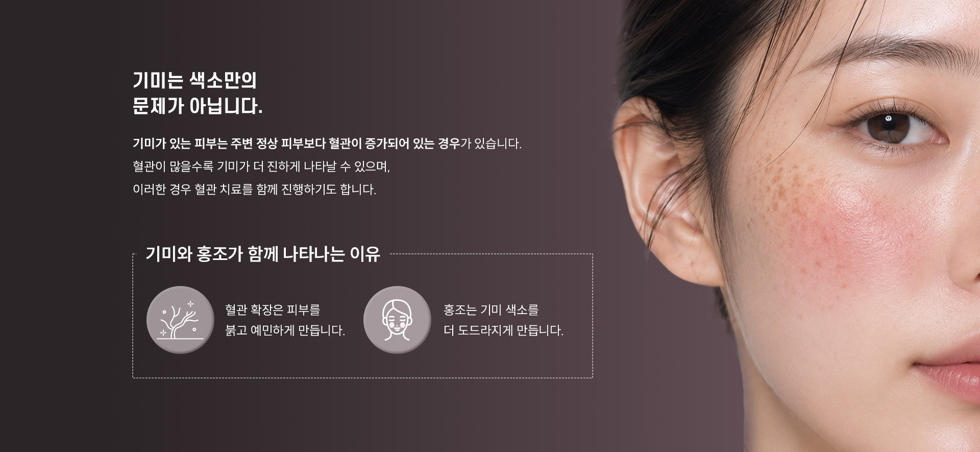 
	기미는 색소만의 문제가 아닙니다.
	기미가 있는 피부는 주변 정상 피부보다 혈관이 증가되어 있는 경우가 있습니다.
	혈관이 많을수록 기미가 더 진하게 나타날 수 있으며, 이러한 경우 혈관 치료를 함께 진행하기도 합니다.
	기미와 홍조가 함께 나타나는 이유
	- 혈관 확장은 피부를 붉고 예민하게 만듭니다.
	- 홍조는 기미 색소를 더 도드라지게 만듭니다.
	