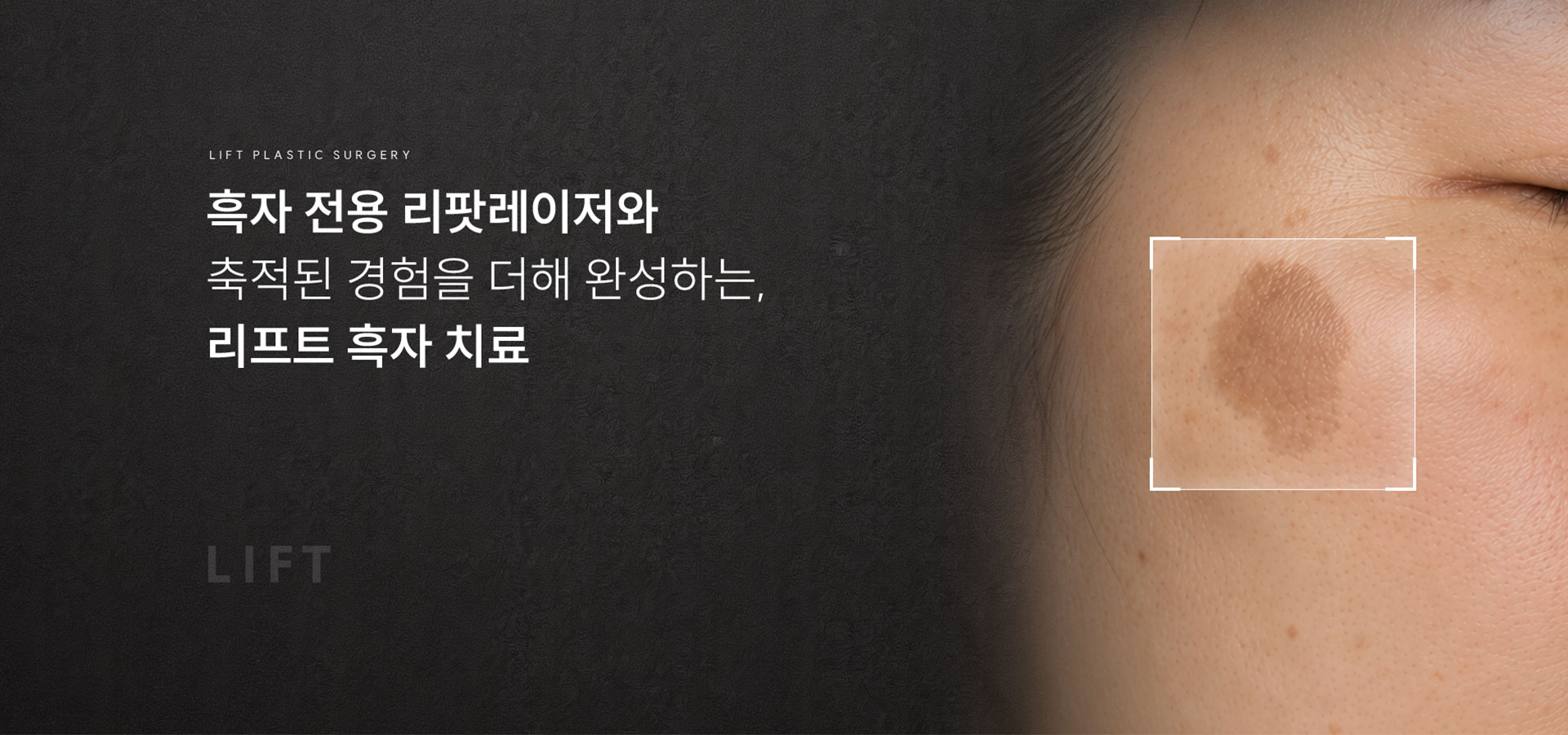 
	1.	흑자 치료, 어떤 방법으로 제대로 치료해야 할까요?
	“흑자 전용 리팟레이저와 축적된 경험을 더해 완성하는, 리프트 흑자 치료”
	