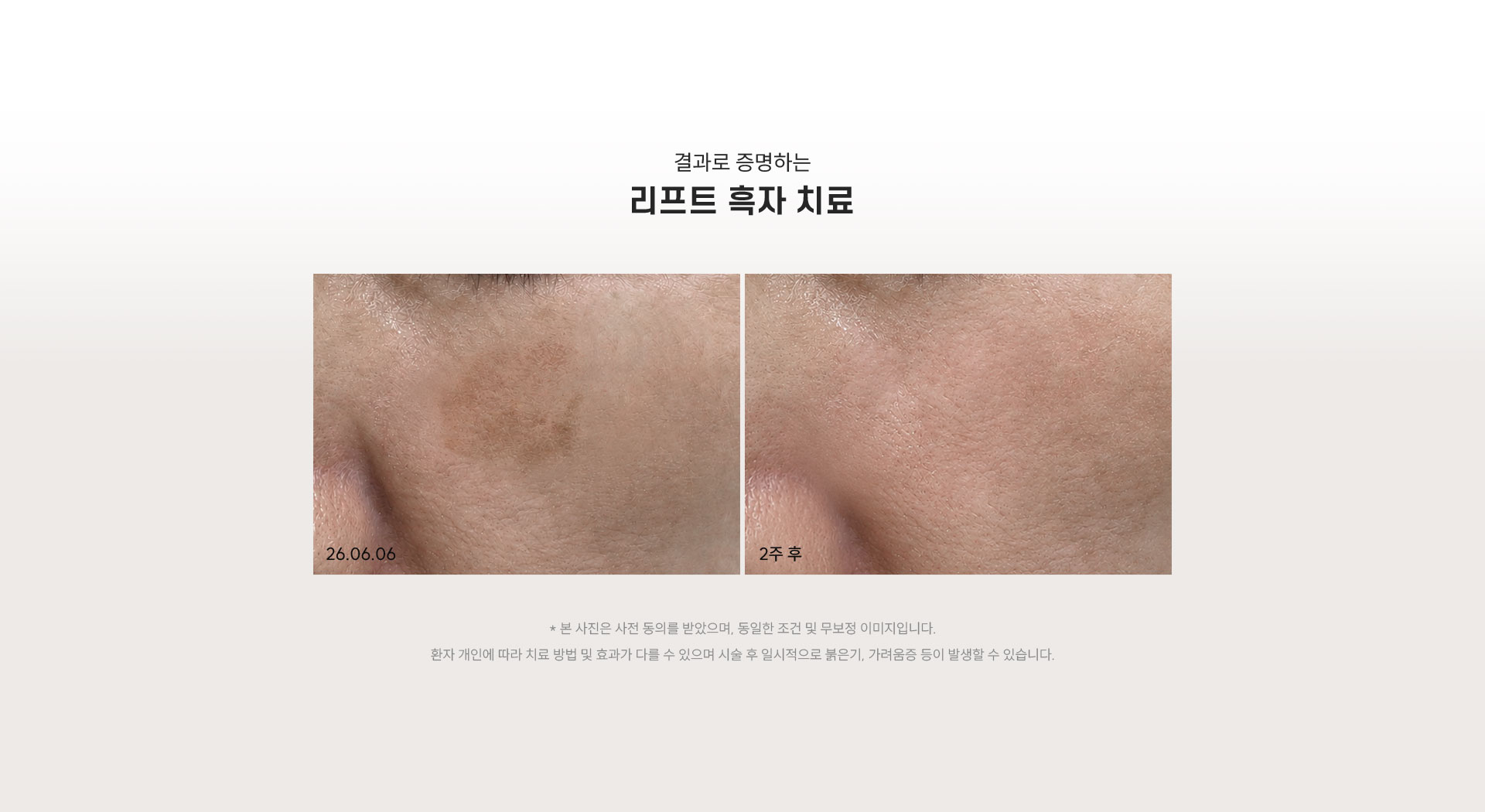 
	2.	결과로 증명하는 리프트 흑자 치료, 실제 변화는 어떨까요?
	결과로 증명하는 리프트 흑자 치료
	[흑자 치료 전·후 비교 이미지]
	•	본 사진은 사전 동의를 받았으며, 동일한 조건 및 무보정 이미지입니다.
	환자 개인에 따라 치료 방법 및 효과가 다를 수 있으며 시술 후 일시적으로 붉은기, 가려움증 등이 발생할 수 있습니다.
