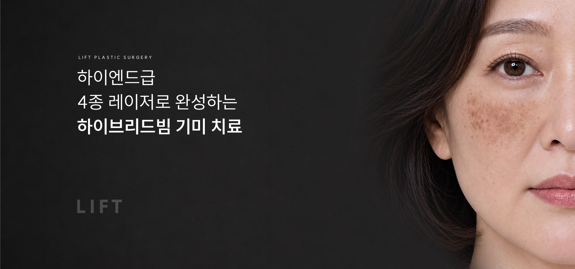 
	하이브리드빔 기미 치료, 기미는 여러 레이저를 조합해야 합니다.
	