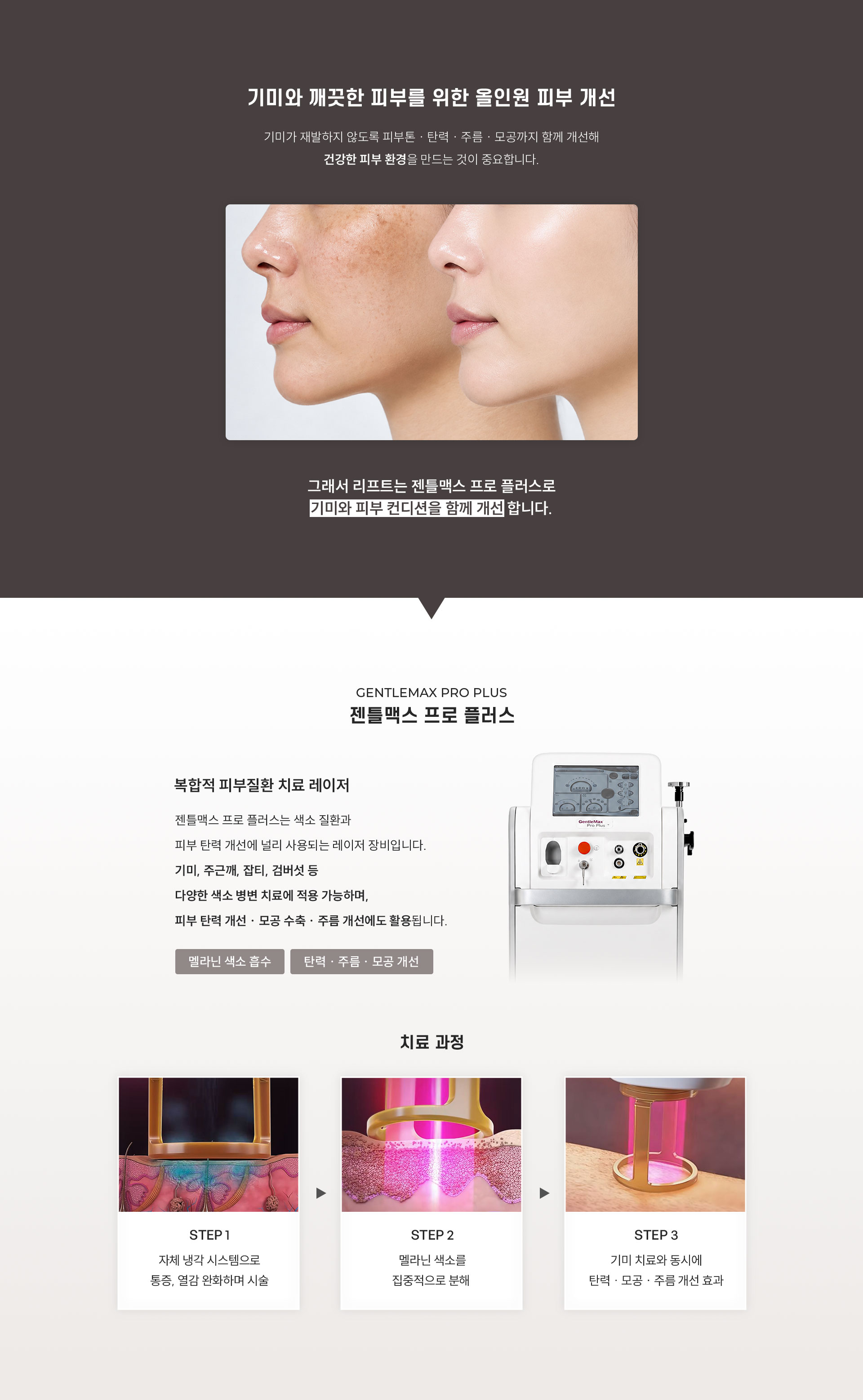 
	Q. 젠틀맥스프로플러스는 어떤 레이저인가요?
	A.복합적 피부질환 치료레이저 젠틀맥스프로플러스
	
