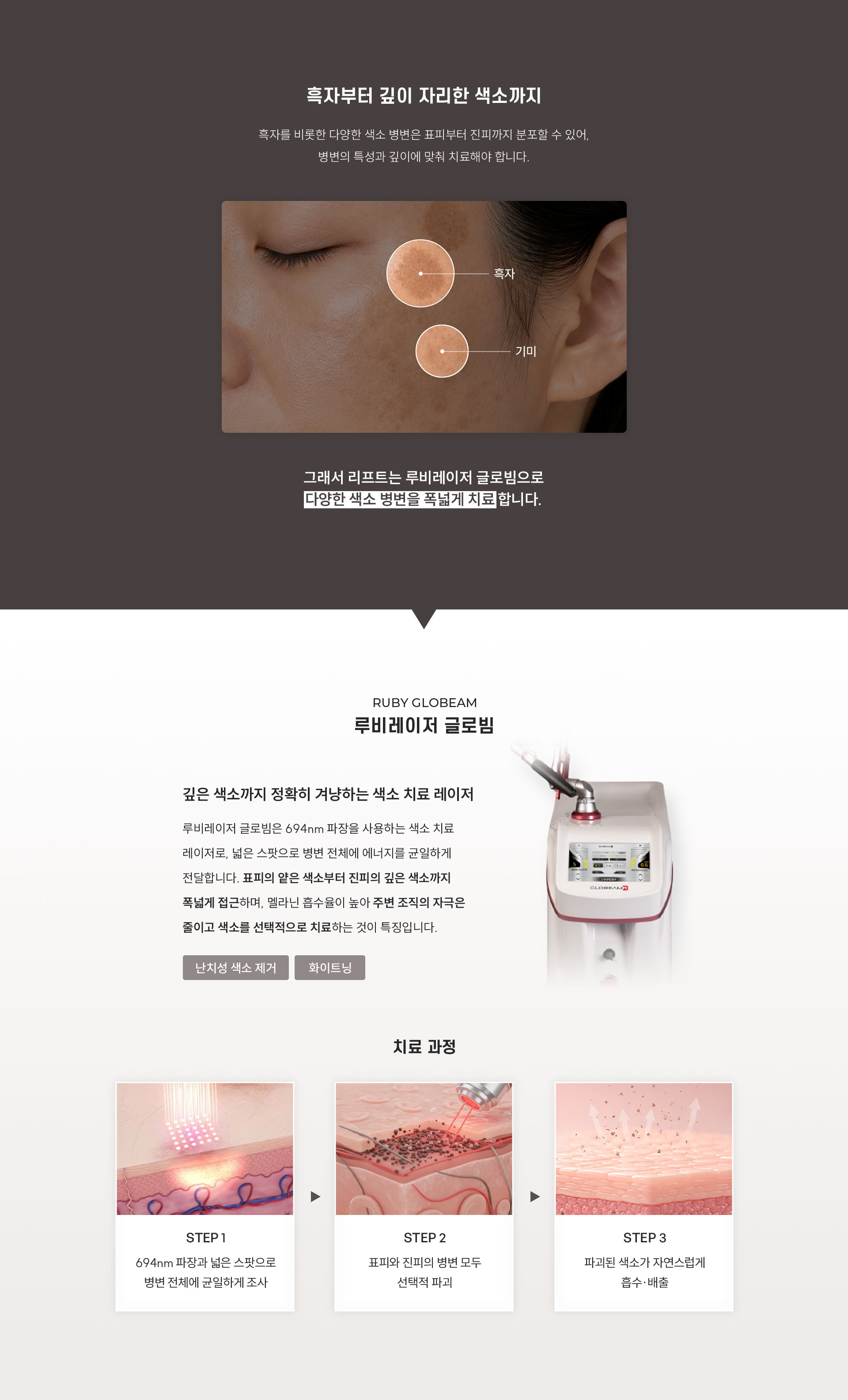 
	Q. 루비레이저 글로빔은 어떤 레이저인가요?
	A.694nm, 파장으로 색소만 정확히 겨냥합니다.
	루비 레이저는 694nm 파장으로 병변 전체를 넓은 스팟을 균일하게 조사하는 색소 치료 레이저 입니다. 표피의 얕은 색소와 진피 깊이있는 색소 양쪽 모두에 접근할 수 있습니다. 멜라닌 흡수율이 높아 색소에 선택적으로 접근하여 치료가 가능합니다. 주변 조직 자극은 줄이면서 폭넓은 색소 치료가 가능한 레이저입니다.
	1.	깊은 색소까지 정밀하게
	•	깊은 색소까지 정밀하게 타겟하여 효율적인 색소 치료를 돕습니다.
	2.	멜라닌 색소만 정확하게
	•	멜라닌 색소만 정확하게 조사하여 치료해 주변 조직 손상을 줄여줍니다.
	3.	낮은 수분 흡수
	•	불필요한 열 손상을 줄여 안전하게 시술합니다.
	