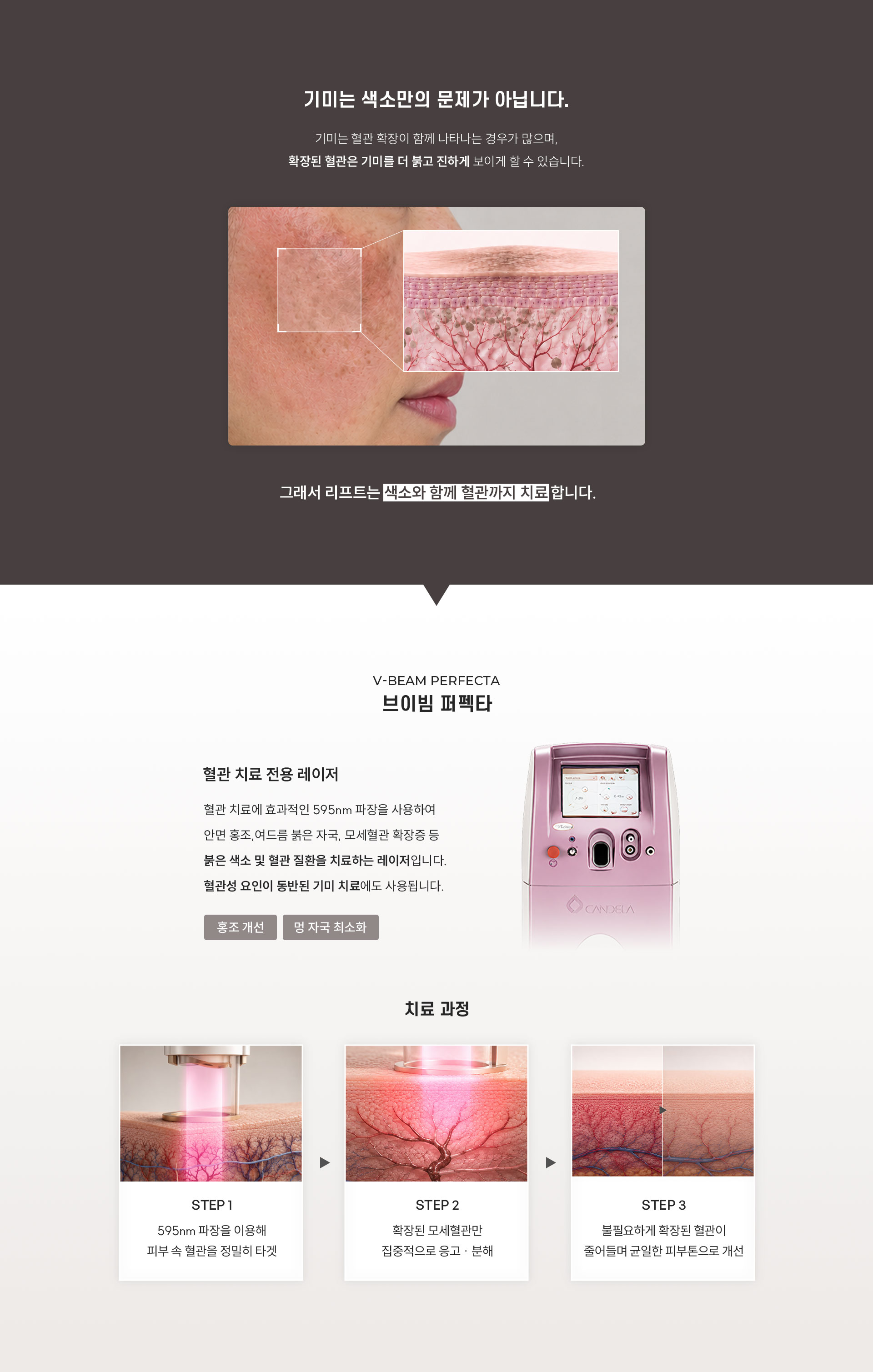 
	Q. 기미는 정말 색소만의 문제일까요?
	A.기미가 있는 피부는 정상 피부보다 혈관이 확장되어 있는 경우가 많습니다. 혈관이 확장 되어 있을 수록 기미가 더 진하게 보일 수 있습니다. 그래서 색소와 혈관을 함께 치료하면 더나은 결과를 기대할 수 있습니다.
	•	혈관 확장은 피부를 붉고 예민하게 만들고 기미를 진하게 보이게 합니다.
	•	홍조는 기미 색소를 더 도드라지게 만들어 피부톤이 어두워집니다.

	Q. 브이빔 퍼펙타는 어떤 레이저인가요?
	A.혈관 치료 전용 레이저 브이빔 퍼펙타
	혈관 치료에 효과적인 595nm 파장을 사용하여 안면 홍조, 여드름 붉은 자국, 모세혈관 확장증 등 붉은 색소 및 혈관 질환을 치료하는 레이저입니다. 혈관성 요인이 동반된 기미 치료에도 사용됩니다.
	▶ 그래서 리프트는 브이빔 퍼펙타로 혈관 치료를 함께 진행합니다.
	Q. 브이빔 퍼펙타 키닥터란 무엇인가요?
	•	켄델라가 인정한 공식 임상자문의로서 축적된 경험을 바탕으로 시술합니다.

	Q. 브이빔 퍼펙타 임상자문의에게 진료받아야 하는 이유는 무엇인가요?
	A.
	•	켄델라 공식 임상자문의가 직접 상담하고 시술합니다.
	1.	브이빔 퍼펙타, 이젠 리주버네이션으로도 활용
	2.	임상자문의 강의 연자 전종호 원장
	3.	당신의 피부를 위한 색소 치료, 올바른 이해로 시작하는 첫 걸음
	