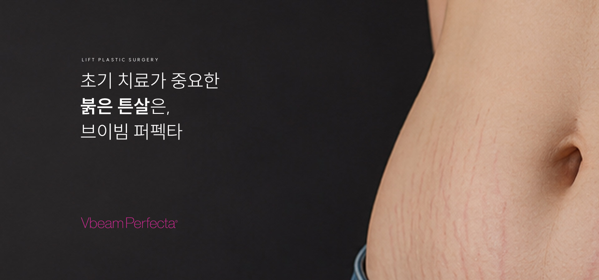 
	초기 치료가 중요한 붉은 튼살은 브이빔 퍼펙타
	