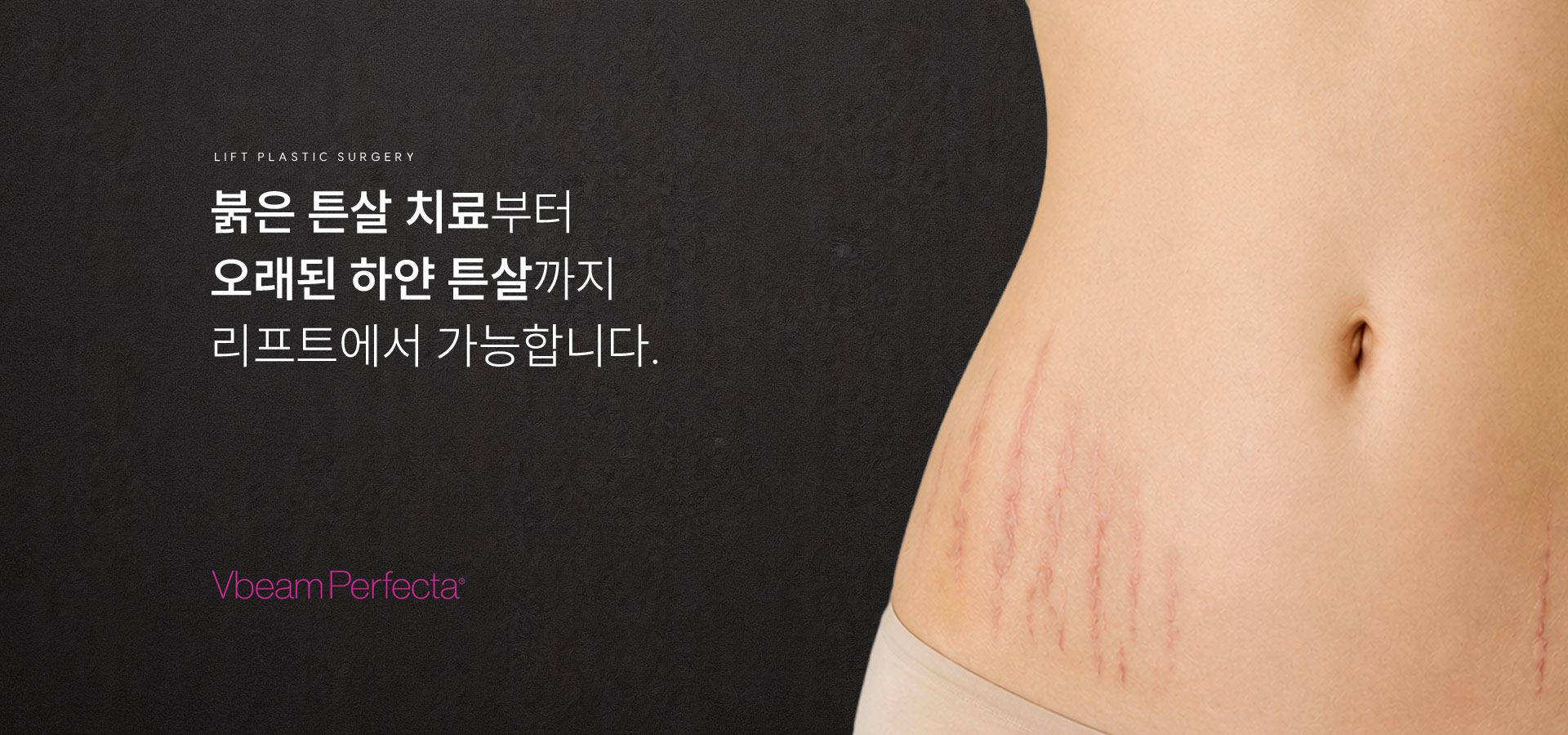 
	“붉은 튼살 치료부터 오래된 하얀 튼살까지 리프트에서 가능합니다.”
	