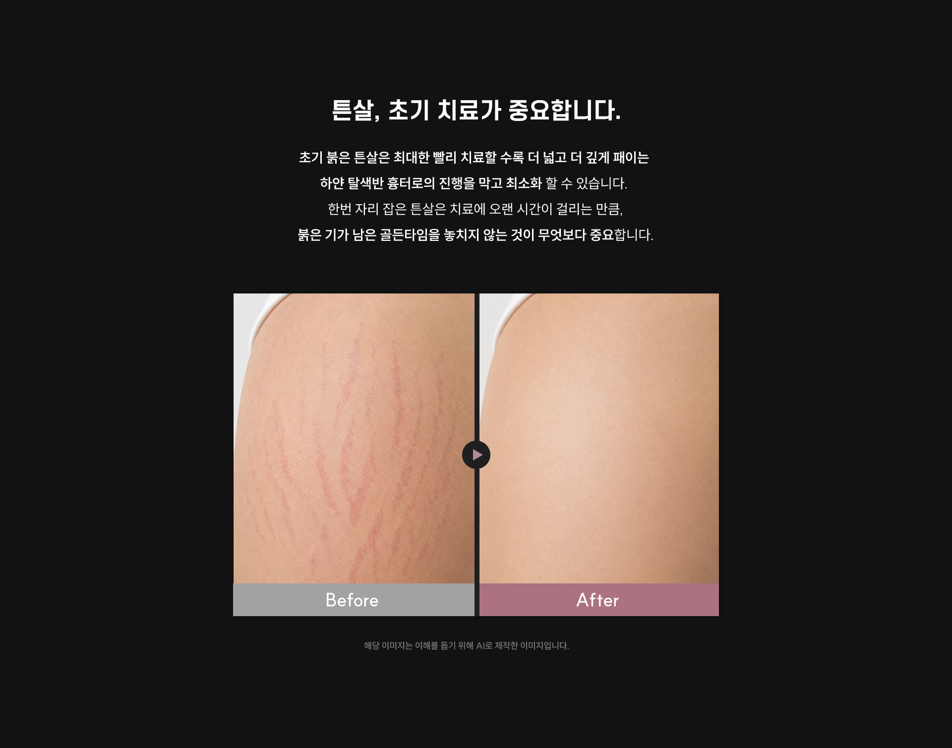 
	1. 튼살은 왜 초기 치료가 중요할까요?
	초기 붉은 튼살은 최대한 빨리 치료할 수록 더 넓고 더 깊게 패이는 하얀 탈색반 흉터로의 진행을 막고 최소화 할 수 있습니다. 꾸준한 치료를 통해 튼살의 길이와 폭을 줄이고 피부의 질감을 개선하여 정상 피부에 가까운 모습으로 회복할 수 있습니다.
	
