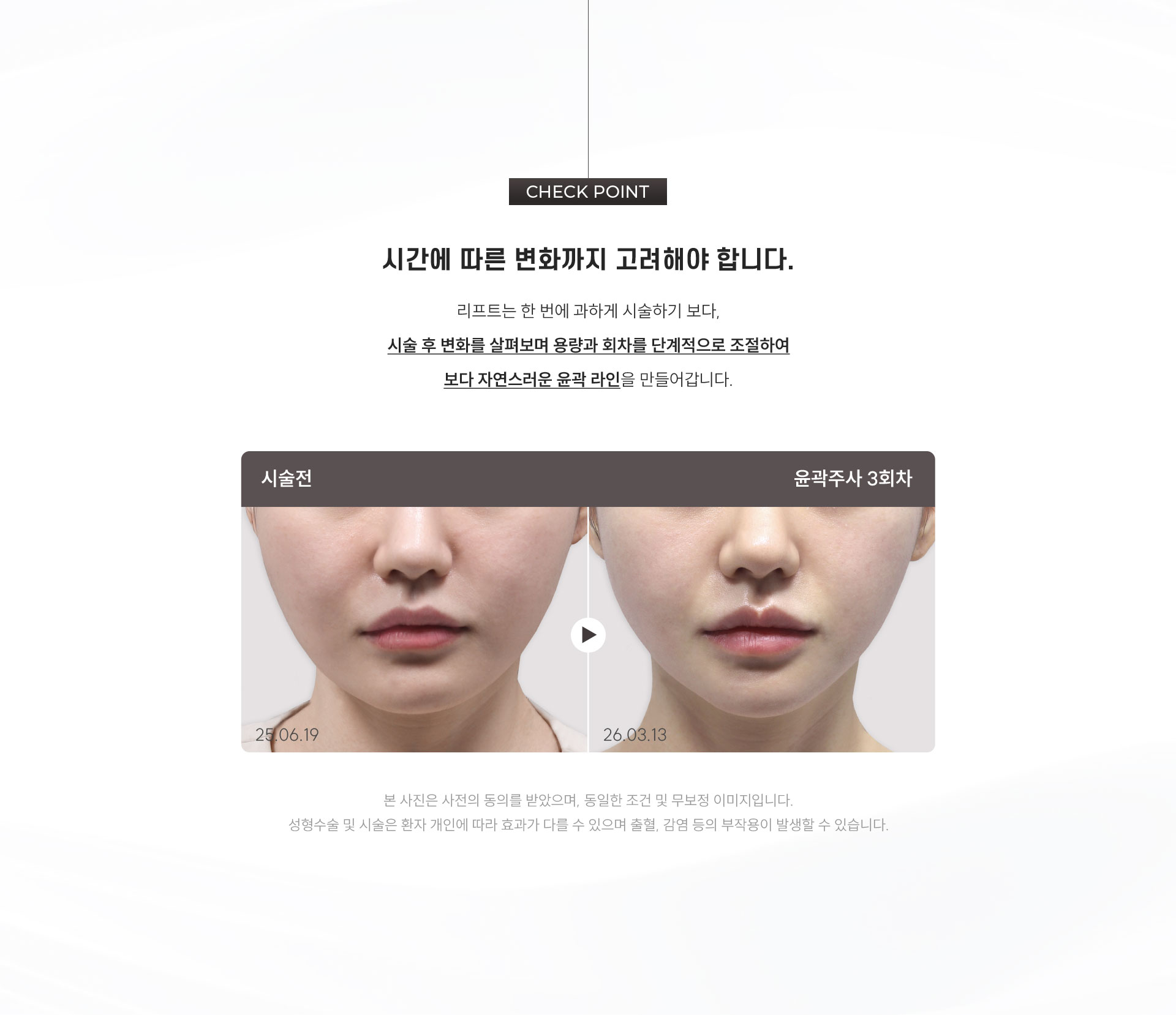 
	5.	시간에 따른 변화까지 고려해야 하는 이유는?

		리프트는 한 번에 과하게 시술하기 보다,
		시술 후 변화를 살펴보며 용량과 회차를 단계적으로 조절하여
		보다 자연스러운 윤곽 라인을 만들어갑니다.
	