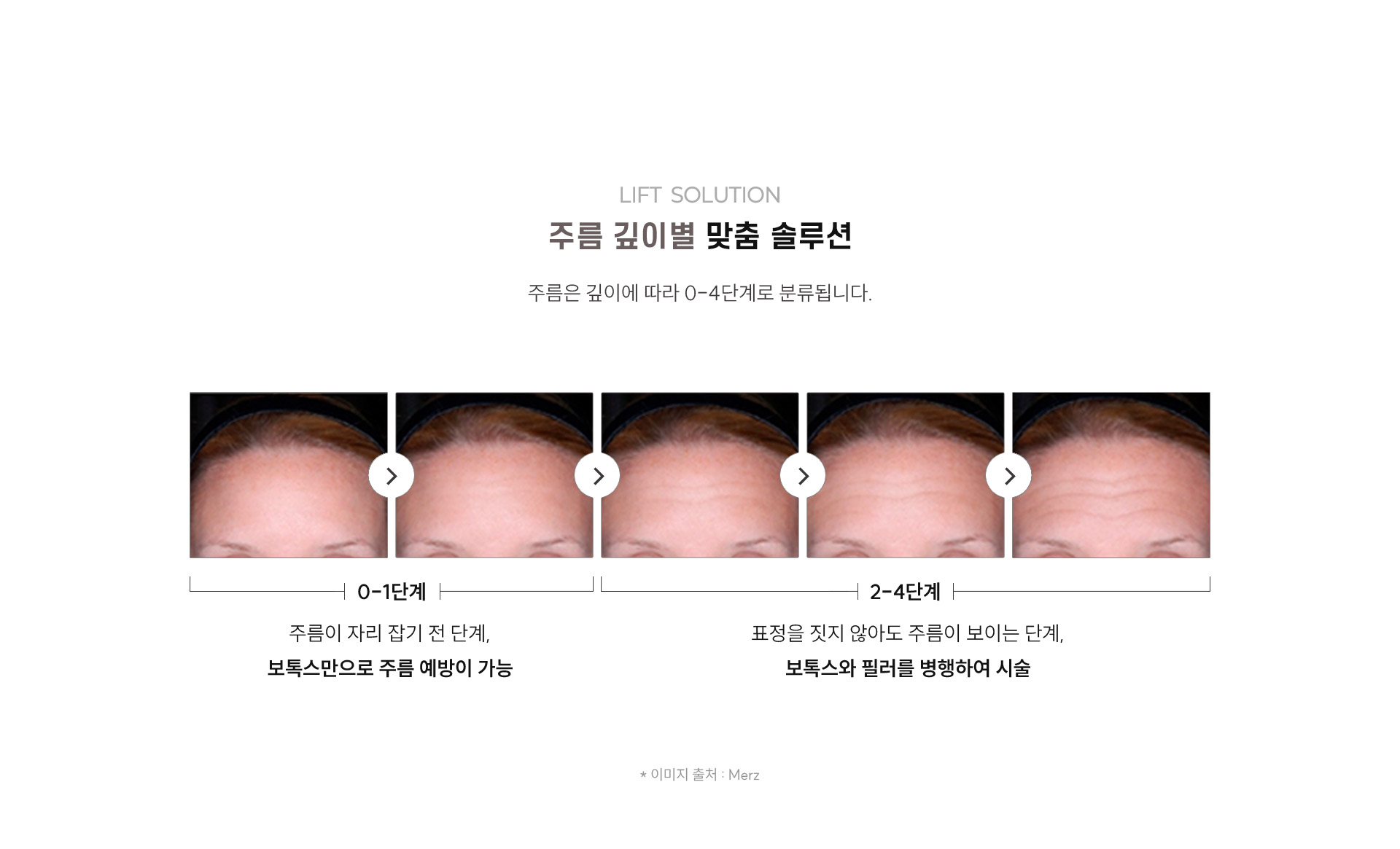 
	4.리프트성형외과의 주름 깊이별 맞춤 솔루션이란?
	주름은 깊이에 따라 0-4단계로 분류됩니다.

	- 0-1단계: 주름이 자리 잡기 전 단계, 보톡스만으로 주름 예방이 가능
	- 2-4단계: 표정을 짓지 않아도 주름이 보이는 단계, 보톡스와 필러를 병행하여 시술
	