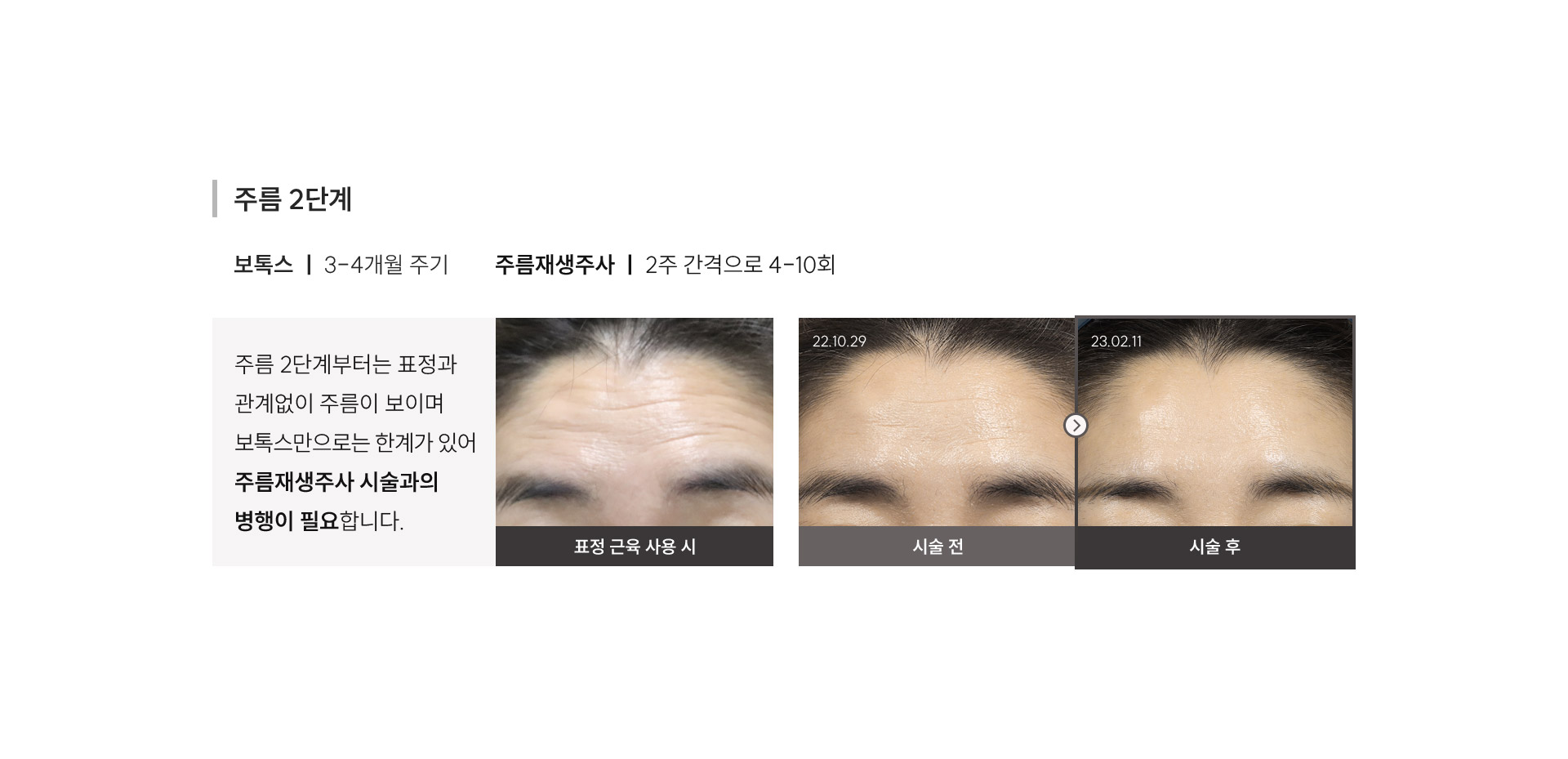 
	2) 주름 2단계
	보톡스: 3-4개월 주기
	주름재생주사: 2주 간격으로 4-10회
	주름 2단계부터는 표정과 관계없이 주름이 보이며, 보톡스만으로는 한계가 있어 주름재생주사 시술과의 병행이 필요합니다.
	