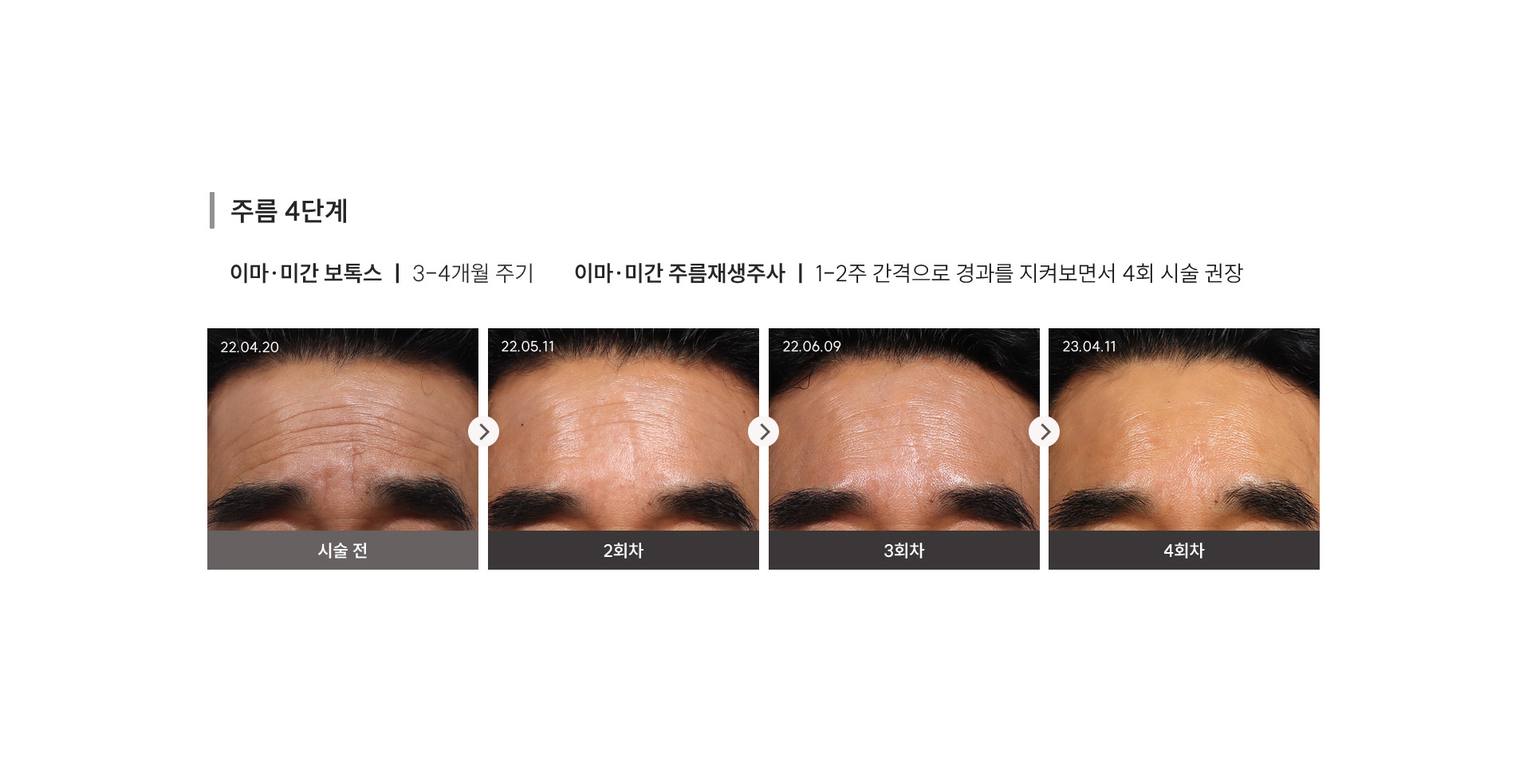 
	4) 주름 4단계
	이마/미간 보톡스: 3-4개월 주기
	이마/미간 주름재생주사: 1-2주 간격으로 경과를 지켜보면서4회 시술 권장
	