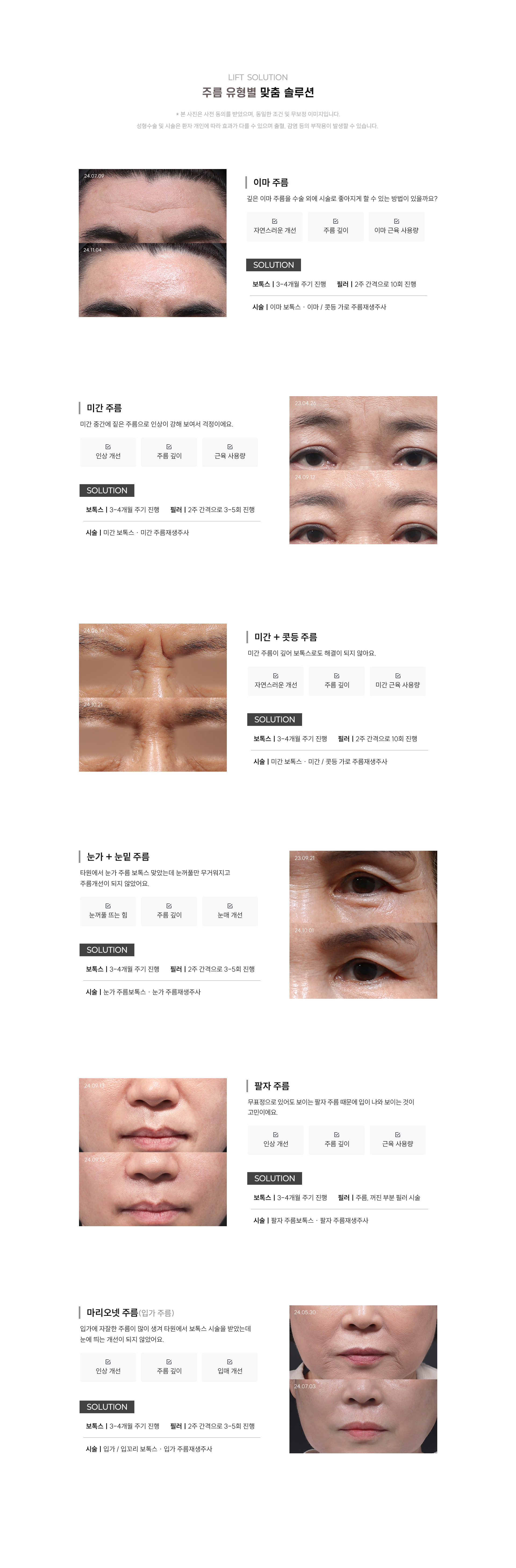 
	6.리프트성형외과의 주름 유형별 맞춤 솔루션이란?
	1) 이마주름
	깊은 이마 주름을 수술 외에 시술로 좋아지게 할 수 있는 방법이 있을까요?
	- 자연스러운 개선/주름 깊이/이마 근육 사용량
		보톡스: 3-4개월 주기 진행
		필러: 2주 간격으로 10회 진행
		시술: 이마 보톡스·이마/콧등 가로 주름재생주사

	2) 미간주름
	미간 중간에 짙은 주름으로 인상이 강해 보여서 걱정이에요.
	- 인상 개선/주름 깊이/근육 사용량
	보톡스: 3-4개월 주기 진행
	필러: 2주 간격으로 3-5회 진행
	시술: 미간 보톡스·미간 주름재생주사

	3) 미간+콧등주름
	미간 주름이 깊어 보톡스로도 해결이 되지 않아요.
	- 자연스러운 개선/주름 깊이/미간 근육 사용량
	보톡스: 3-4개월 주기 진행
	필러: 2주 간격으로 10회 진행
	시술: 미간 보톡스·미간 주름재생주사

	4) 눈가+눈밑주름
	타원에서 눈가 주름 보톡스 맞았는데 눈꺼풀만 무거워지고 주름개선이 되지 않았어요.
	- 눈꺼풀 뜨는 힘/주름 깊이/눈매 개선
	보톡스: 3-4개월 주기 진행
	필러: 2주 간격으로 3-5회 진행
	시술: 눈가 주름보톡스·눈가 주름재생주사

	5) 팔자주름
	무표정으로 있어도 보이는 팔자 주름 때문에 입이 나와 보이는 것이 고민이에요. 
	- 인상 개선/주름 깊이/근육 사용량
	보톡스: 3-4개월 주기 진행
	필러: 주름, 꺼진 부분 필러 시술 
	시술: 팔자 주름보톡스·팔자 주름재생주사

	6) 마리오넷 주름(입가 주름)
	입가에 자잘한 주름이 많이 생겨 타원에서 보톡스 시술을 받았는데 눈에 띄는 개선이 되지 않았어요.
	- 인상 개선/주름 깊이/입매 개선
	보톡스: 3-4개월 주기 진행
	필러: 2주 간격으로 3-5회 진행 
	시술: 입가/입꼬리 보톡스·입가 주름재생주사
	