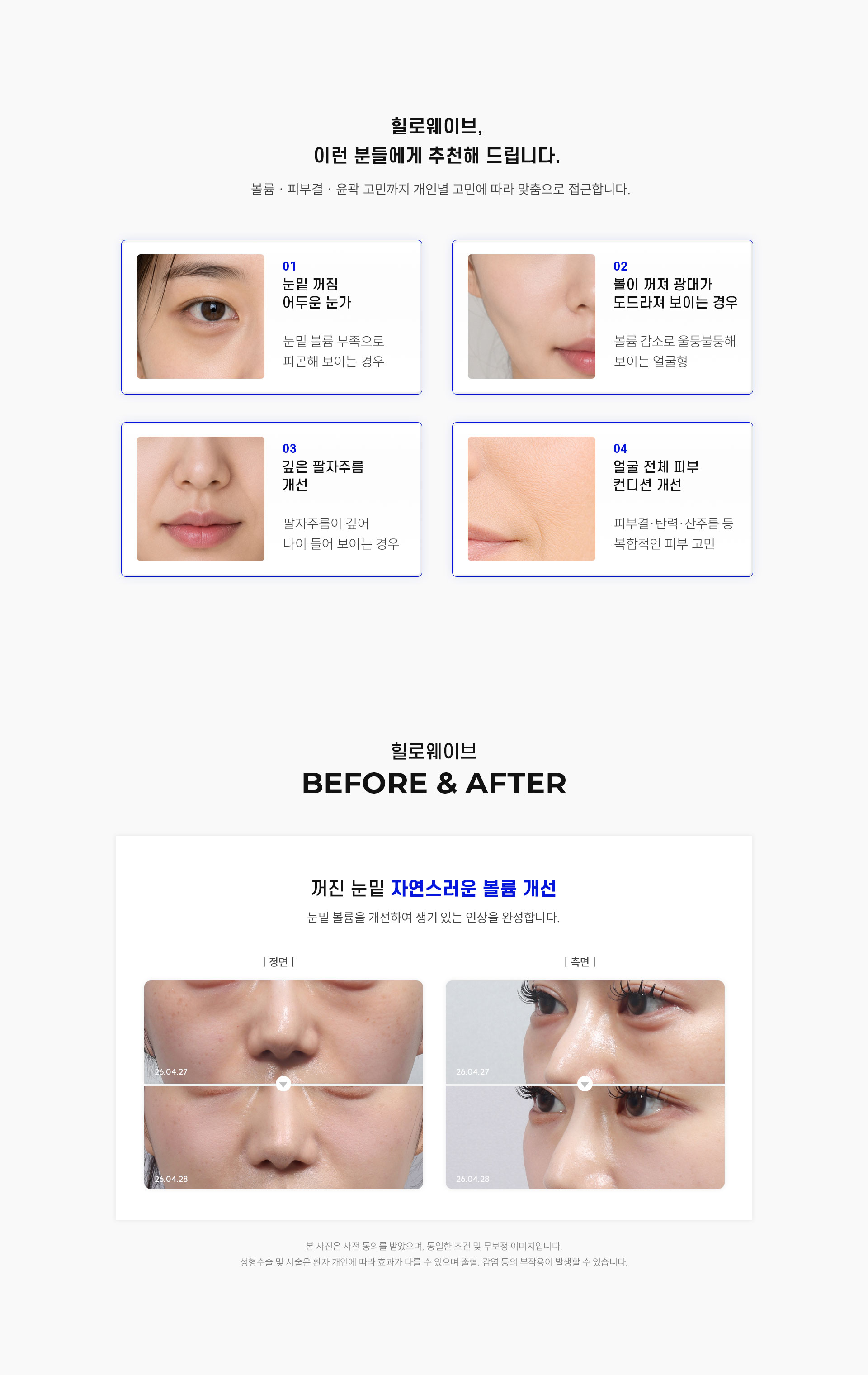 
		7.	대구힐로웨이브, 추천 대상은?
		볼륨 · 피부결 · 윤곽 고민까지 개인별 고민에 따라 맞춤으로 접근합니다.
		1)	눈밑 꺼짐, 어두운 눈가
		눈밑 볼륨 부족으로 피곤해 보이는 경우
		2)	볼이 꺼져 광대가 도드라져 보이는 경우
		볼륨 감소로 울퉁불퉁해 보이는 얼굴형
		3)	깊은 팔자주름 개선
		팔자주름이 깊어 나이 들어 보이는 경우
		4)	얼굴 전체 피부 컨디션 개선
		피부결·탄력·잔주름 등 복합적인 피부 고민
		
		8.	대구힐로웨이브 전후 사진
		꺼진 눈밑 자연스러운 볼륨 개선
		눈밑 볼륨을 개선하여 생기 있는 인상을 완성합니다.
		