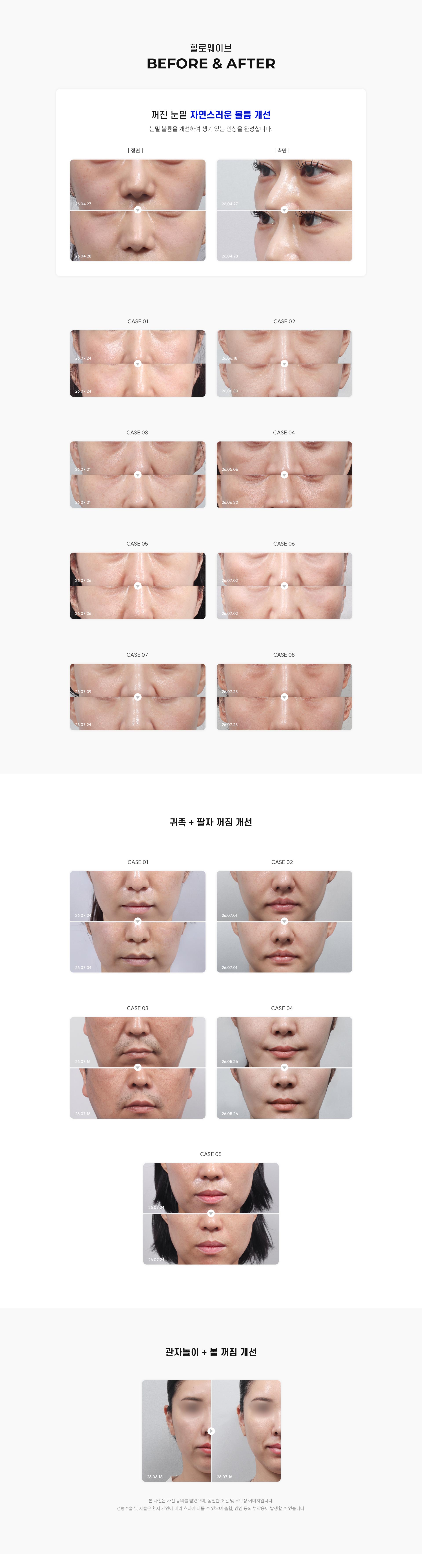 
		8.	대구힐로웨이브 전후 사진
		꺼진 눈밑 자연스러운 볼륨 개선
		눈밑 볼륨을 개선하여 생기 있는 인상을 완성합니다.
		